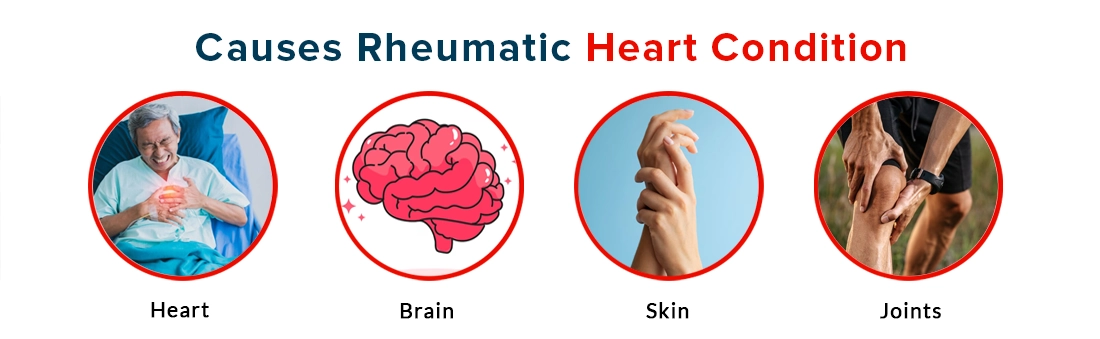 Causes of Rheumatic Heart Condition